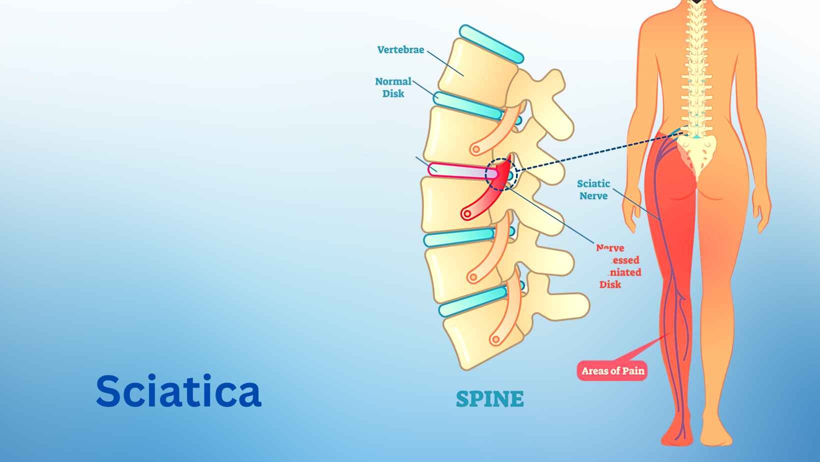 Best Physiotherapy Treatment Centre In Modinagar for Sciatica Treatment?