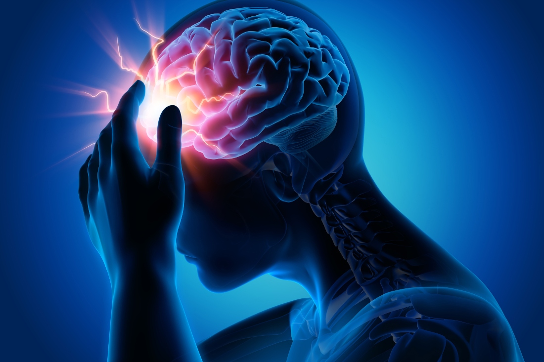 Can Physiotherapy Help Treat Migraine Naturally?